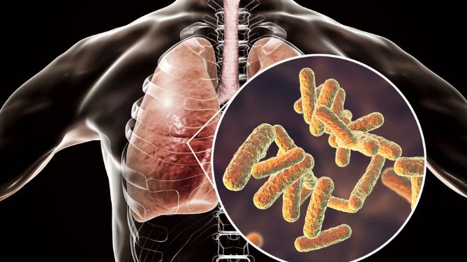 klebsiella-pneumoniae-bacterie-resistante-des poumons-et-voies-urinaires-elsan-actualites-sante